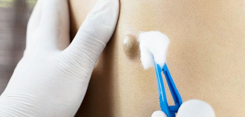 Torbiel włosowa – przebieg choroby, objawy i metody leczenia