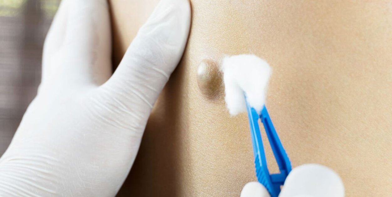 Torbiel włosowa – przebieg choroby, objawy i metody leczenia